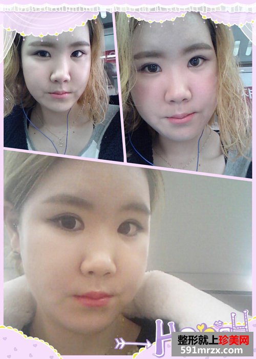 ��������+���ͽ�����ǰ��Ч���Ա�ͼ�ͻָ�����