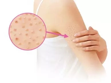 110����֬�ݶ���(110����֬�ݶ��ٺ���)