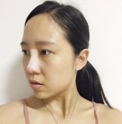 西安医学院第二附属医院整形科隆鼻修复案例和价格费用更新上线~