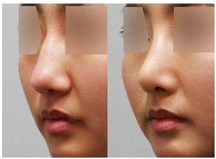 想做耳软骨隆鼻手术不一定适合你!先看看哪些情况适合吧?