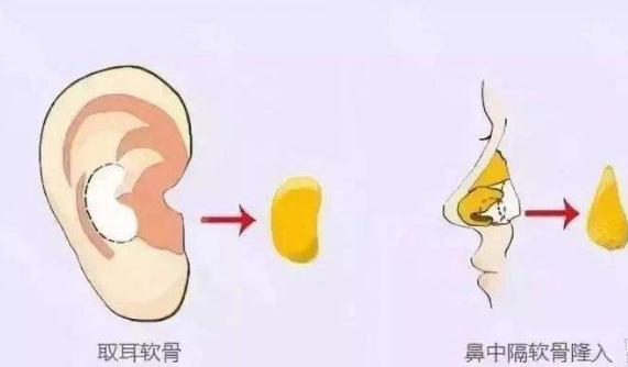想做耳软骨隆鼻手术不一定适合你!先看看哪些情况适合吧?