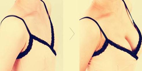 做完假体隆胸手术,学会这个趴床方法恢复快!