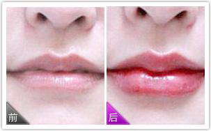 唇部脱毛大概要多少钱