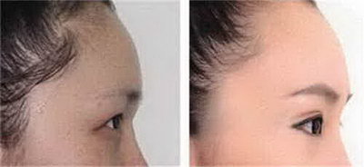 眉心有竖纹的男人命运怎么样