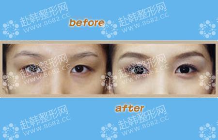 埋线双眼皮消肿要用多久?