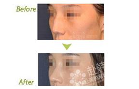 鼻部整形对比照