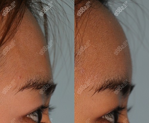 爱护整形医院额头填充前后对比 爱护整形医院额头填充前后对比