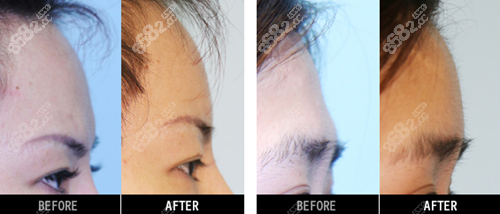 爱护整形医院额头填充案例 爱护整形医院额头填充案例