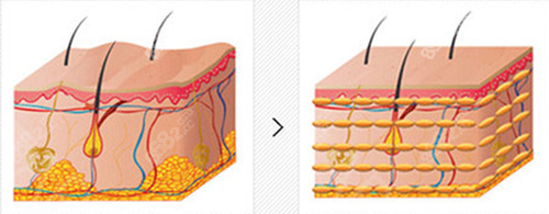 脂肪填充皮肤前后变化 脂肪填充皮肤前后变化
