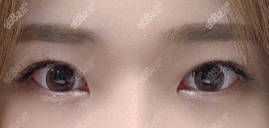 韩国TS整形外科眼修复术后一年效果 韩国TS整形外科眼修复术后一年效果