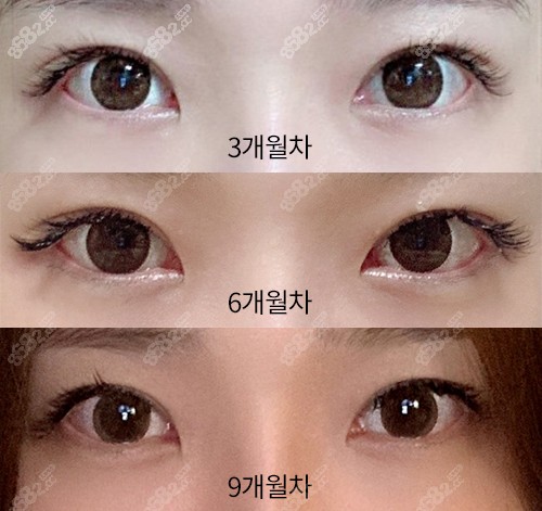 眼修复术后3-9个月恢复对比 眼修复术后3-9个月恢复对比