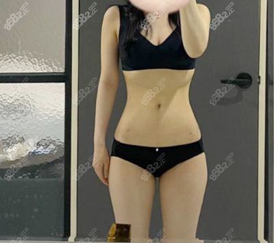 水动力吸脂术后3个月侧面效果图 水动力吸脂术后3个月侧面效果图