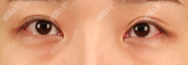 是不是好奇韩国TS李相均院长做眼修复怎么样? 是不是好奇韩国TS李相均院长做眼修复怎么样?