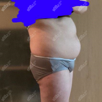 吸脂术前侧面腰腹部照片 吸脂术前侧面腰腹部照片