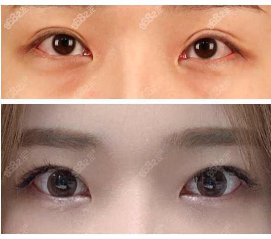 李相均眼修复旗前后对比效果 李相均眼修复旗前后对比效果