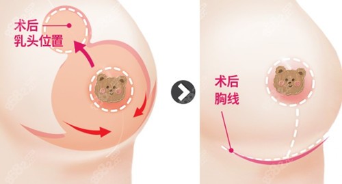 韩国id医院做缩胸手术 韩国id医院做缩胸手术