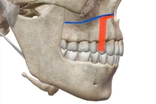 周会喜正颌手术做的怎么样 周会喜正颌手术做的怎么样