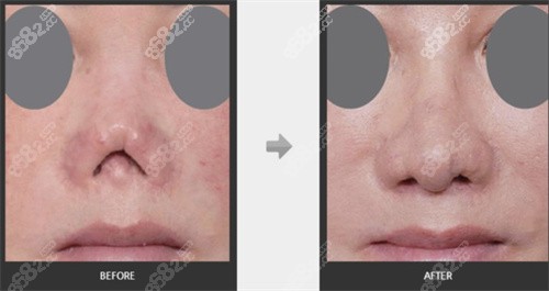 韩国心美眼医院鼻修复二 韩国心美眼医院鼻修复二