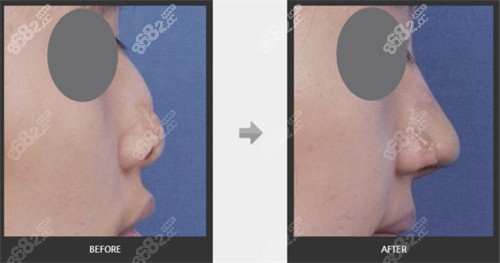 韩国心美眼医院鼻修复一 韩国心美眼医院鼻修复一