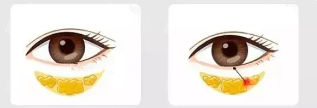 不开刀去眼袋有结果而且结果还不错(m.8682.cc) 不开刀去眼袋有结果而且结果还不错(m.8682.cc)