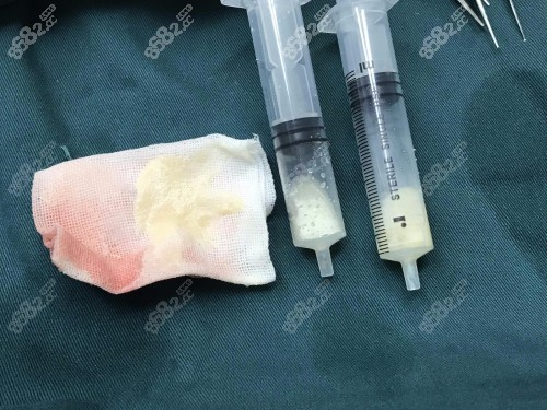 广州荔湾生长因子取出 广州荔湾生长因子取出