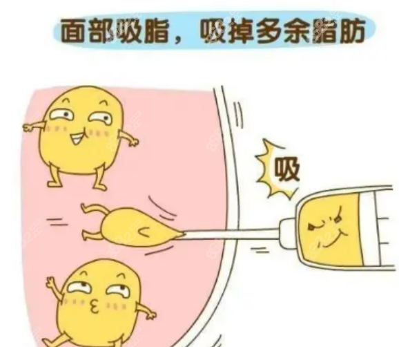 李永峰医生吸脂 李永峰医生吸脂