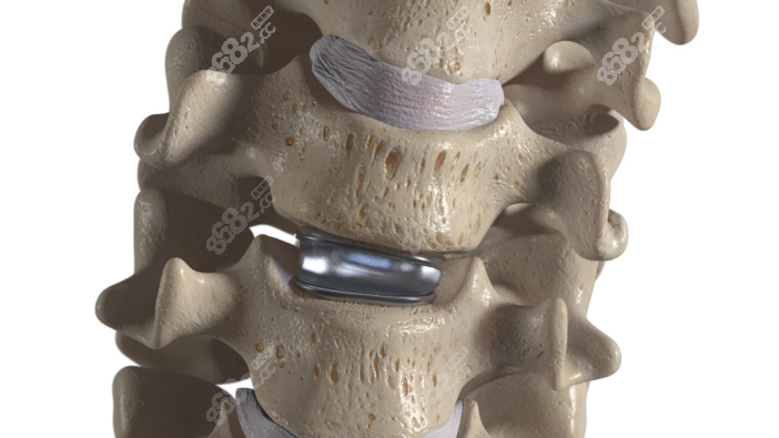 颈椎人工椎间盘置换术费用 颈椎人工椎间盘置换术费用