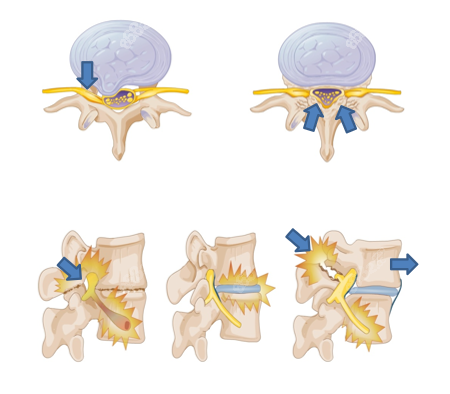腰椎显微椎间盘切除术风险大吗 腰椎显微椎间盘切除术风险大吗