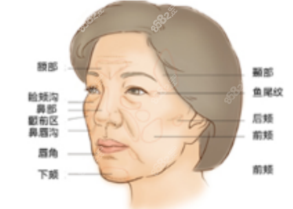 李永峰医生面部填充 李永峰医生面部填充