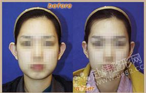 耳部整形对比照