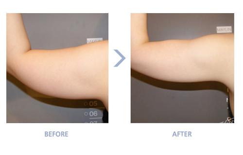 fanta-plus(高周波溶解脂肪)手臂溶脂