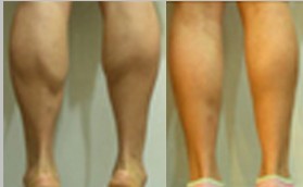 吸脂瘦身 小腿吸脂