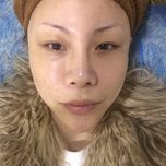 在深圳做了4次激光祛斑的恢复效果，真的干净了