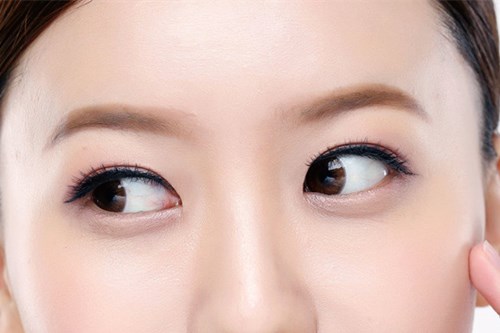 除泪沟手术的风险1.jpg 除泪沟手术的风险1.jpg