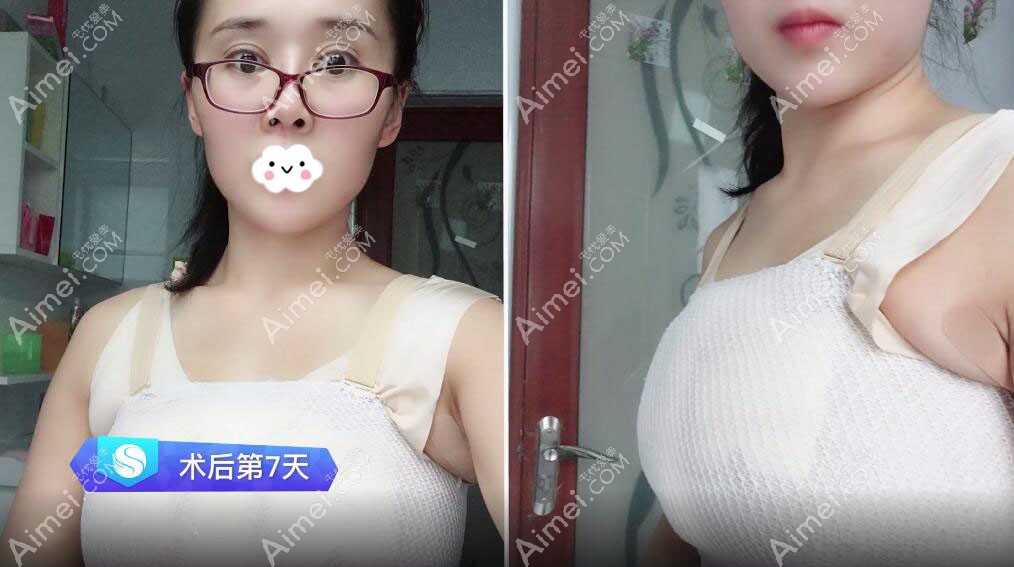 深圳富华唐新辉曼托假体隆胸案例 深圳富华唐新辉曼托假体隆胸案例