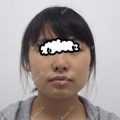 杭州瑞丽何涛主任做5G光雕面部吸脂,休息1个周末就能上班了