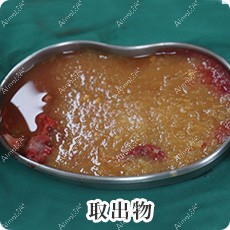 胸部奥美定取出物 胸部奥美定取出物