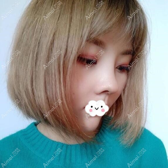 佛山君美整形膨体+半肋软骨隆鼻案例 佛山君美整形膨体+半肋软骨隆鼻案例