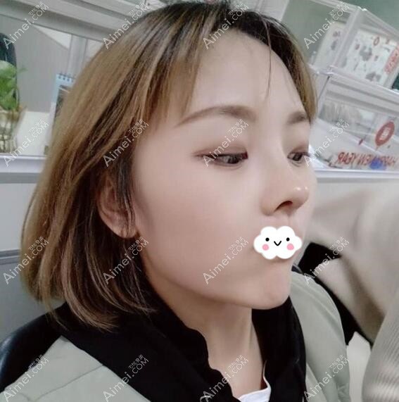 佛山隆鼻哪家好?君美鼻综合案例 佛山隆鼻哪家好?君美鼻综合案例