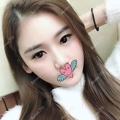 温州星范整形陈德裕院长给我做脂肪填充全脸三个月效果图 温州星范整形陈德裕院长给我做脂肪填充全脸三个月效果图