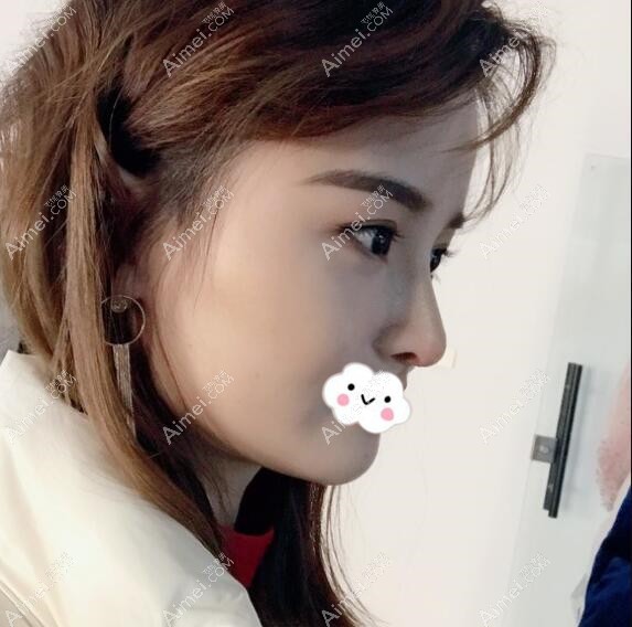 不知成都隆鼻哪家好,参考铜雀台案例 不知成都隆鼻哪家好,参考铜雀台案例