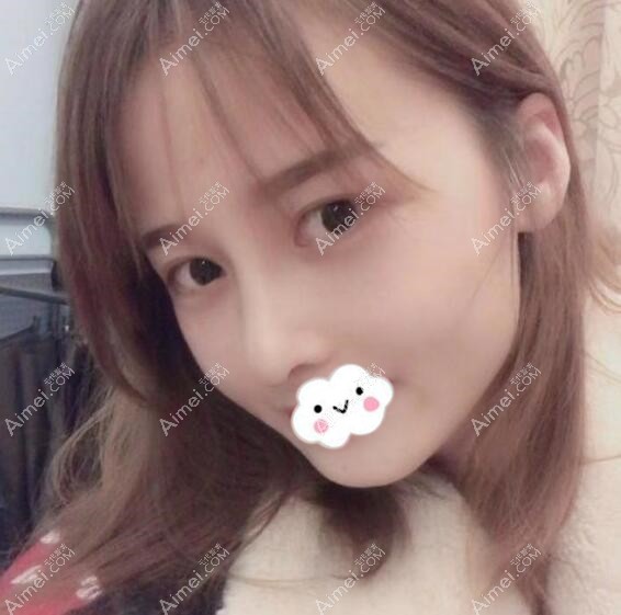 成都铜雀台鼻综合隆鼻案例 成都铜雀台鼻综合隆鼻案例