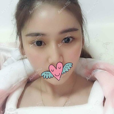 做全脸脂肪填充第15天恢复照片 做全脸脂肪填充第15天恢复照片