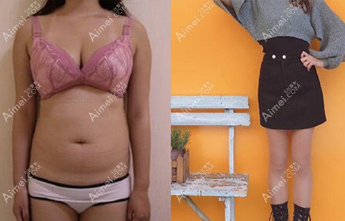 140斤做完全身抽脂能瘦10斤或20斤?是噱头还是真功夫