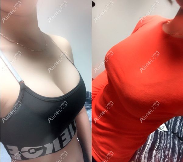 曼托隆胸术后三个月效果 曼托隆胸术后三个月效果