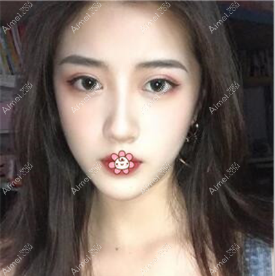 南昌艾莱芙胡洋红双眼皮术后40天 南昌艾莱芙胡洋红双眼皮术后40天