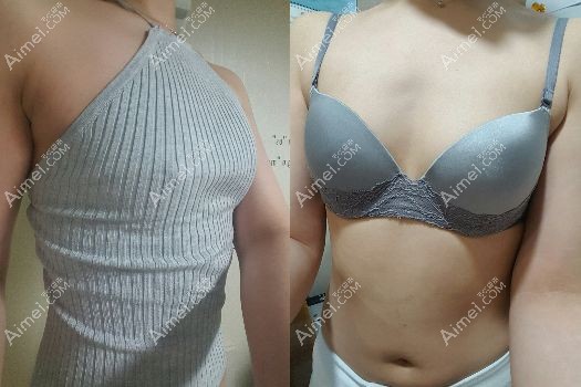 做曼托隆胸术前是75A罩杯 做曼托隆胸术前是75A罩杯