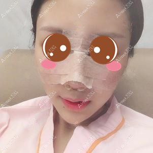 做肋软骨隆鼻后2天 做肋软骨隆鼻后2天