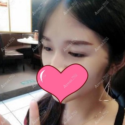 双眼皮术后60天 双眼皮术后60天