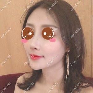 做肋软骨隆鼻后1个月效果 做肋软骨隆鼻后1个月效果